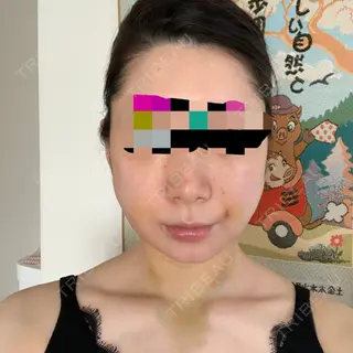 5日目の経過画像（2枚目）