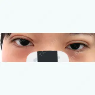 0日目の経過画像（3枚目）