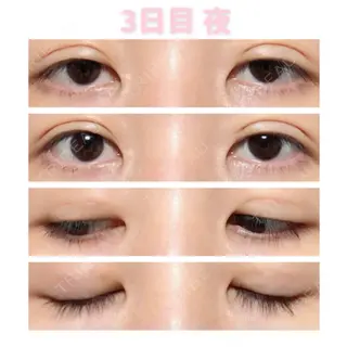 3日目の経過画像（1枚目）