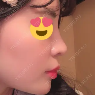 84日目の経過画像（3枚目）