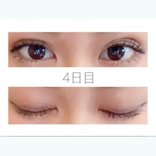 3日目の経過画像（1枚目）