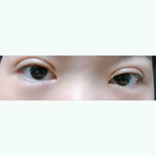 1日目の経過画像（2枚目）