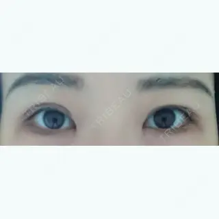 18日目の経過画像（1枚目）