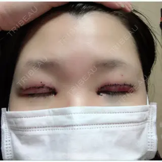 1日目の経過画像（2枚目）