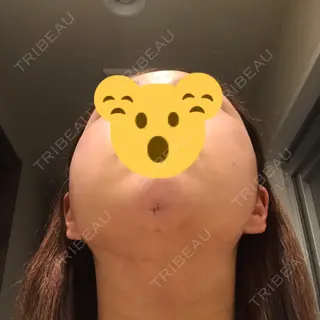 2日目の経過画像（3枚目）
