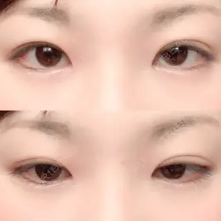 92日目の経過画像（1枚目）