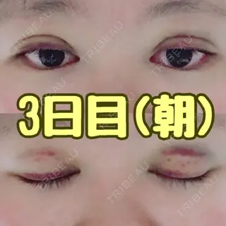 3日目の経過画像（1枚目）