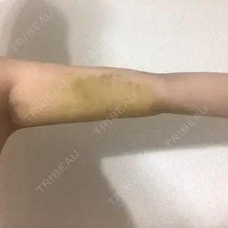 6日目の経過画像（3枚目）