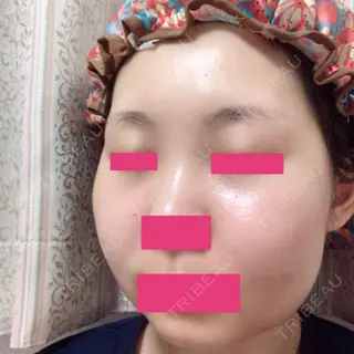25日目の経過画像（2枚目）