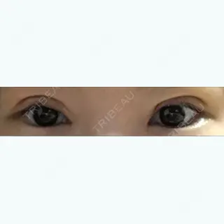 11日目の経過画像（1枚目）