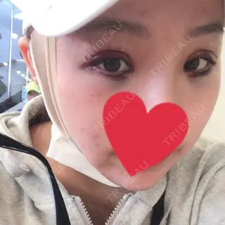 1日目の経過画像（3枚目）