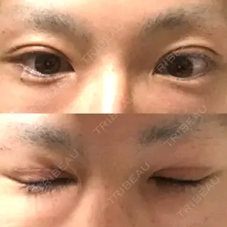 30日目の経過画像（1枚目）