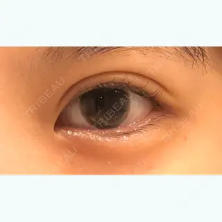 19日目の経過画像（2枚目）