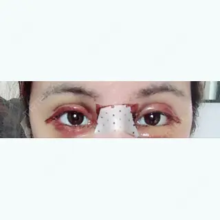 5日目の経過画像（1枚目）