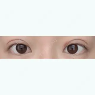 0日目の経過画像（2枚目）