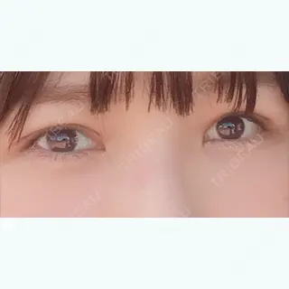 29日目の経過画像（2枚目）