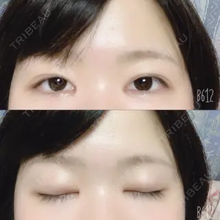 94日目の経過画像（1枚目）