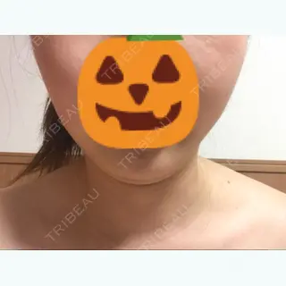 16日目の経過画像（1枚目）