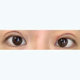 1日目の経過画像（1枚目）