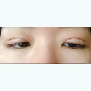 1日目の経過画像（2枚目）