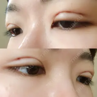 1日目の経過画像（3枚目）