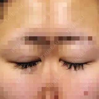 1日目の経過画像（2枚目）