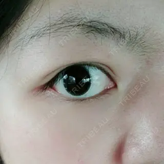 1日目の経過画像（2枚目）