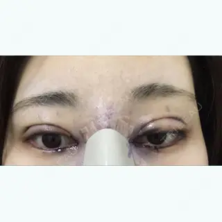 0日目の経過画像（1枚目）