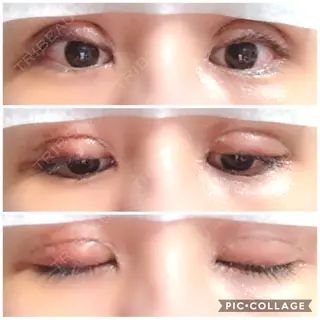 5日目の経過画像（1枚目）