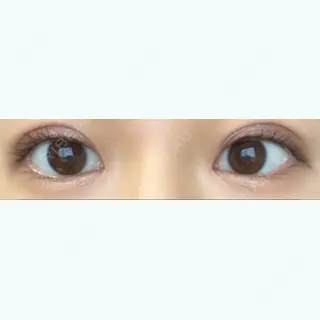 2日目の経過画像（1枚目）