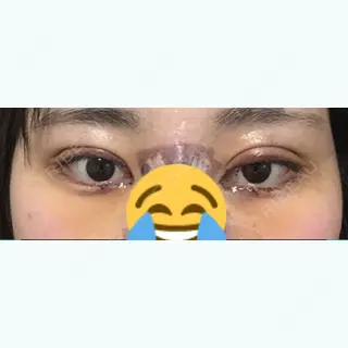 5日目の経過画像（1枚目）
