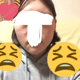 5日目の経過画像（1枚目）