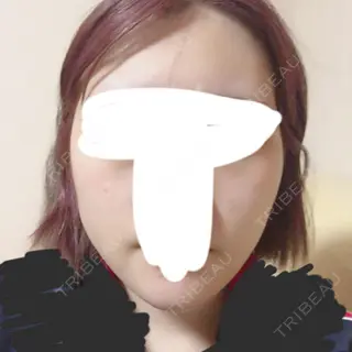 7日目の経過画像（1枚目）
