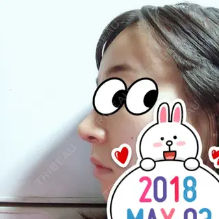 15日目の経過画像（2枚目）