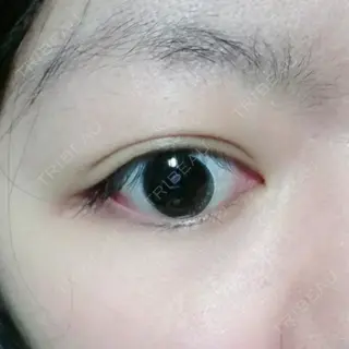 3日目の経過画像（1枚目）