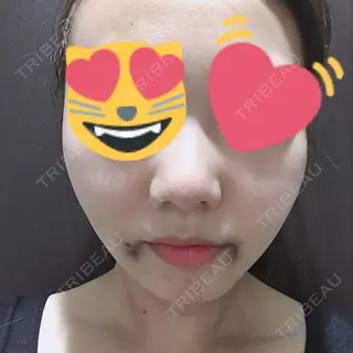 1日目の経過画像（1枚目）