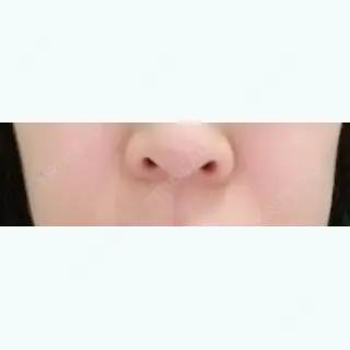 1日目の経過画像（1枚目）