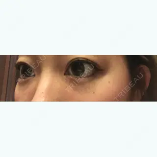 21日目の経過画像（2枚目）