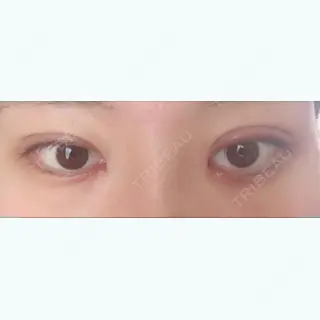17日目の経過画像（1枚目）