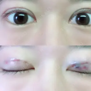 0日目の経過画像（1枚目）
