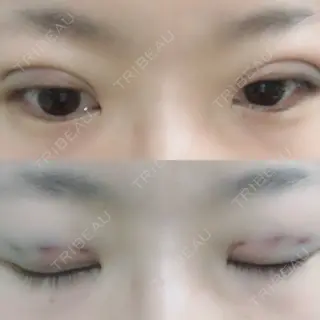 0日目の経過画像（1枚目）