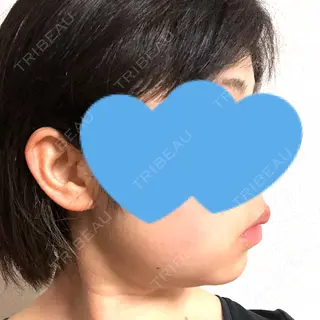 18日目の経過画像（2枚目）