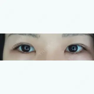 28日目の経過画像（1枚目）