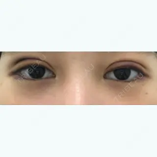 2日目の経過画像（1枚目）