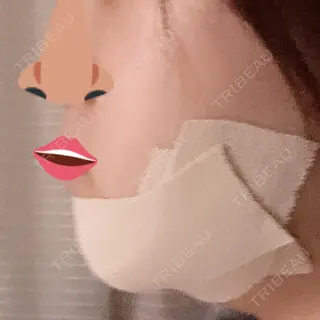 0日目の経過画像（3枚目）