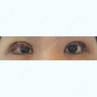 10日目の経過画像（1枚目）
