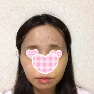 8日目の経過画像（1枚目）