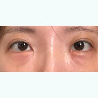 6日目の経過画像（1枚目）
