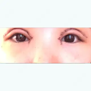 5日目の経過画像（1枚目）