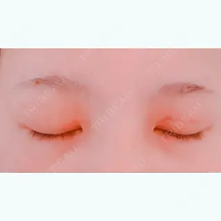1日目の経過画像（2枚目）